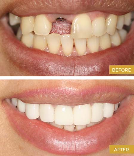 Before and after cosmetic dentistry