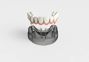Dental prosthetics