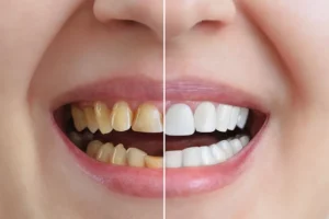 Composite Bonding or Dental Veneers: What is better?
