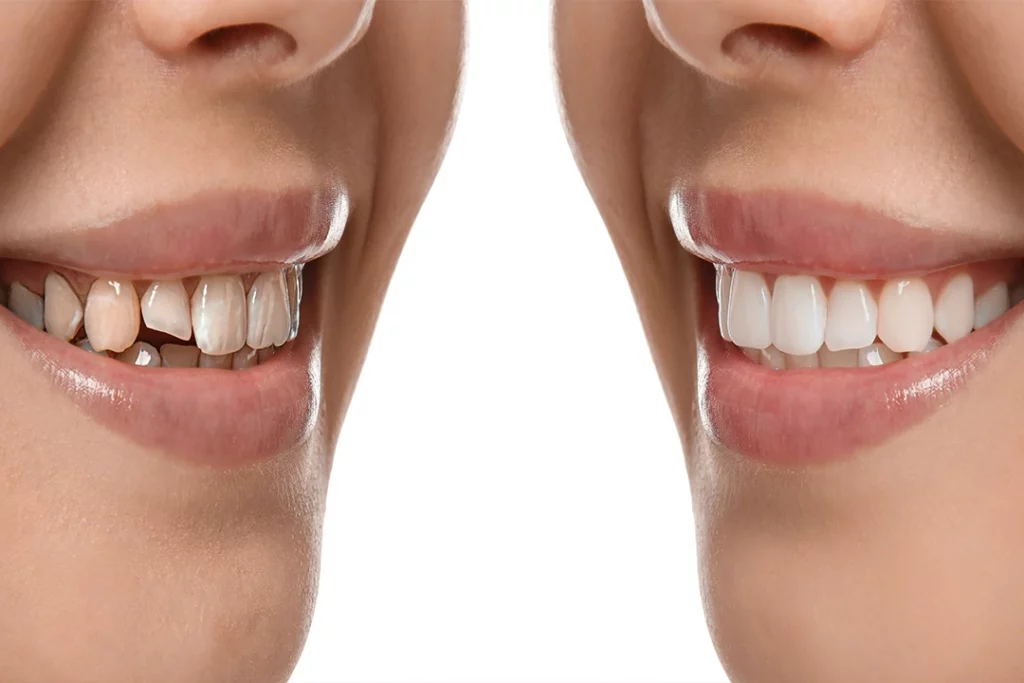 Dental Veneers: Before and After