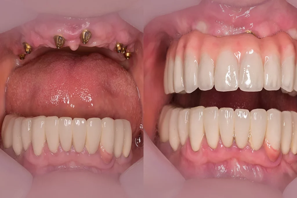 Dentures: Before and After