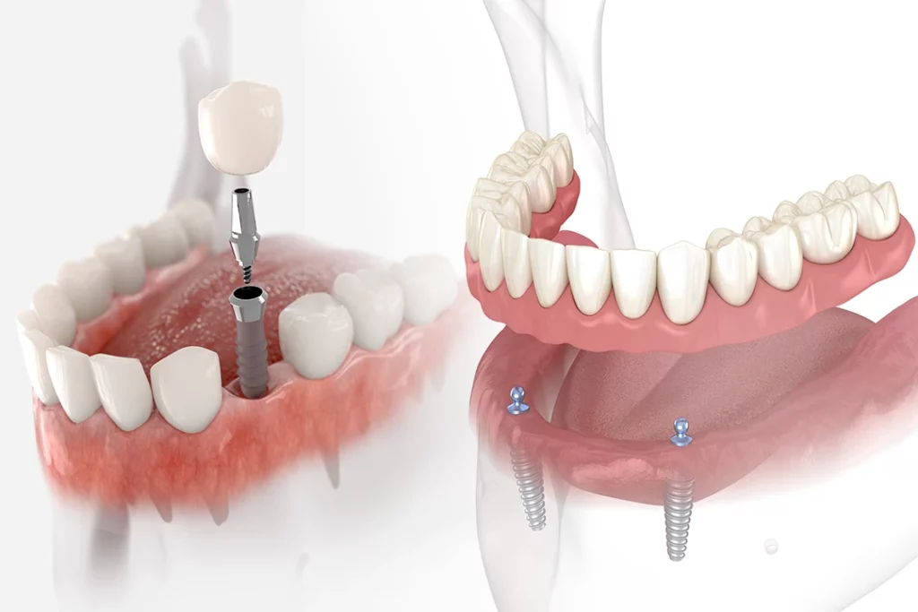 False Teeth vs Bridge: Which is better?