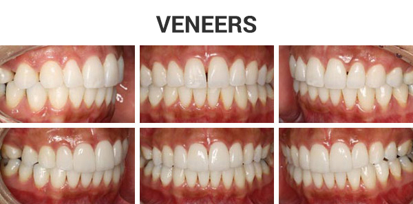 SG-Veneers-08 (1)