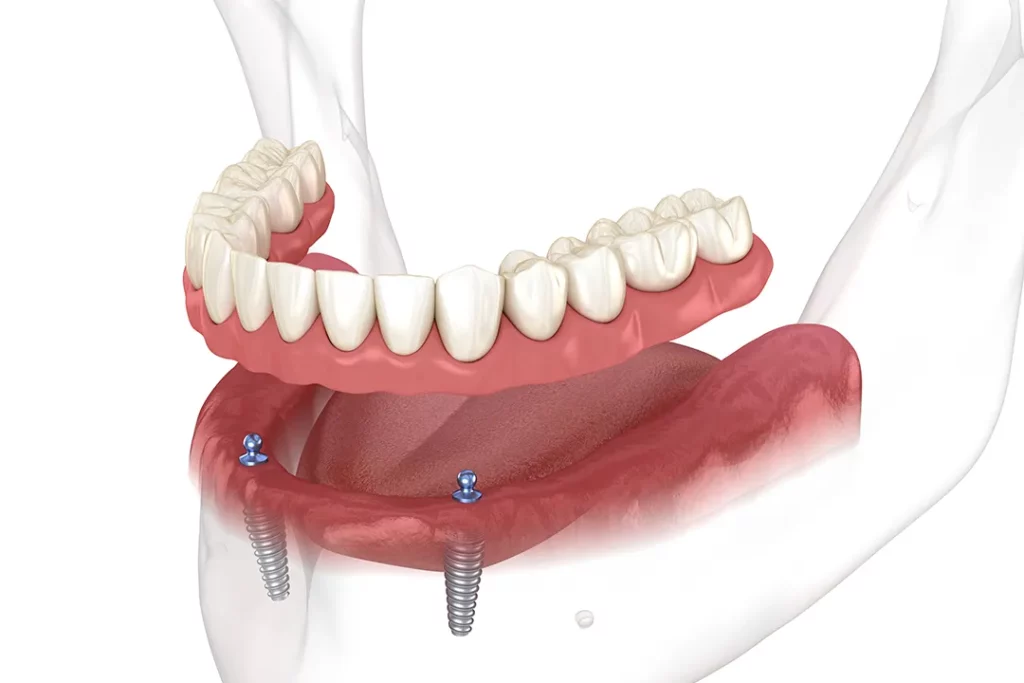 What is the process for denture stabilization?