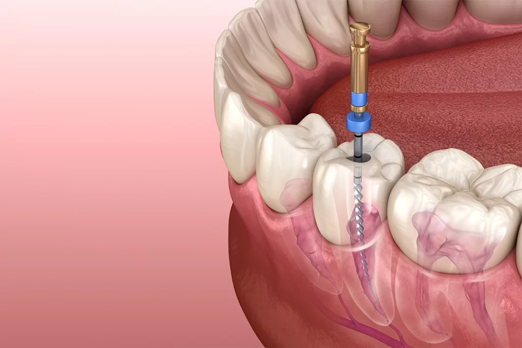 Everything You Need to Know about Root Canal Treatment