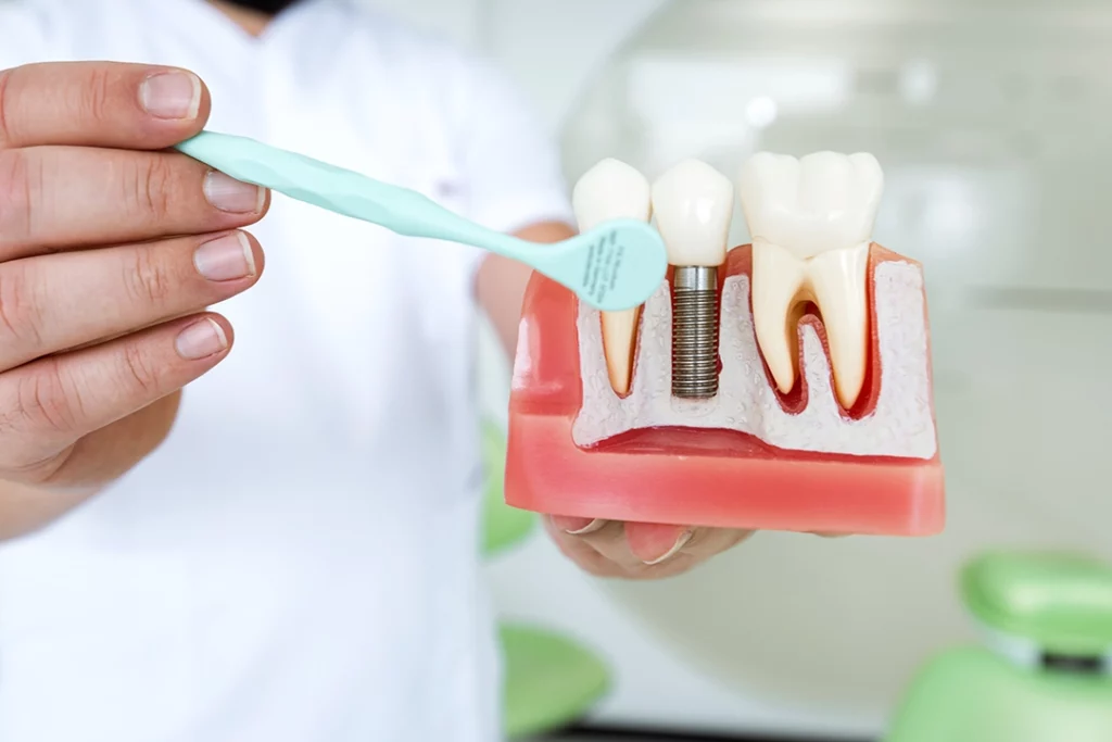 Types of Dental Implants: What You Need to Know Before Treatment