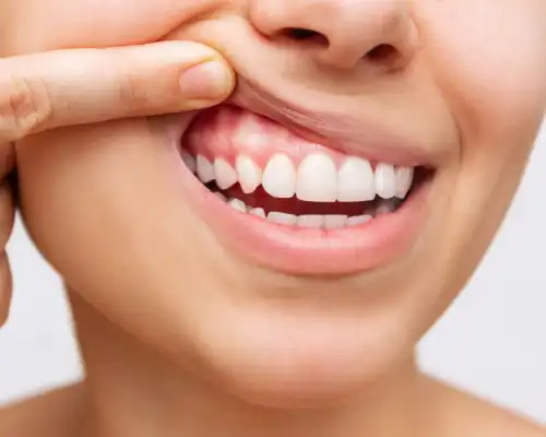 Can Gingivitis Be Cured