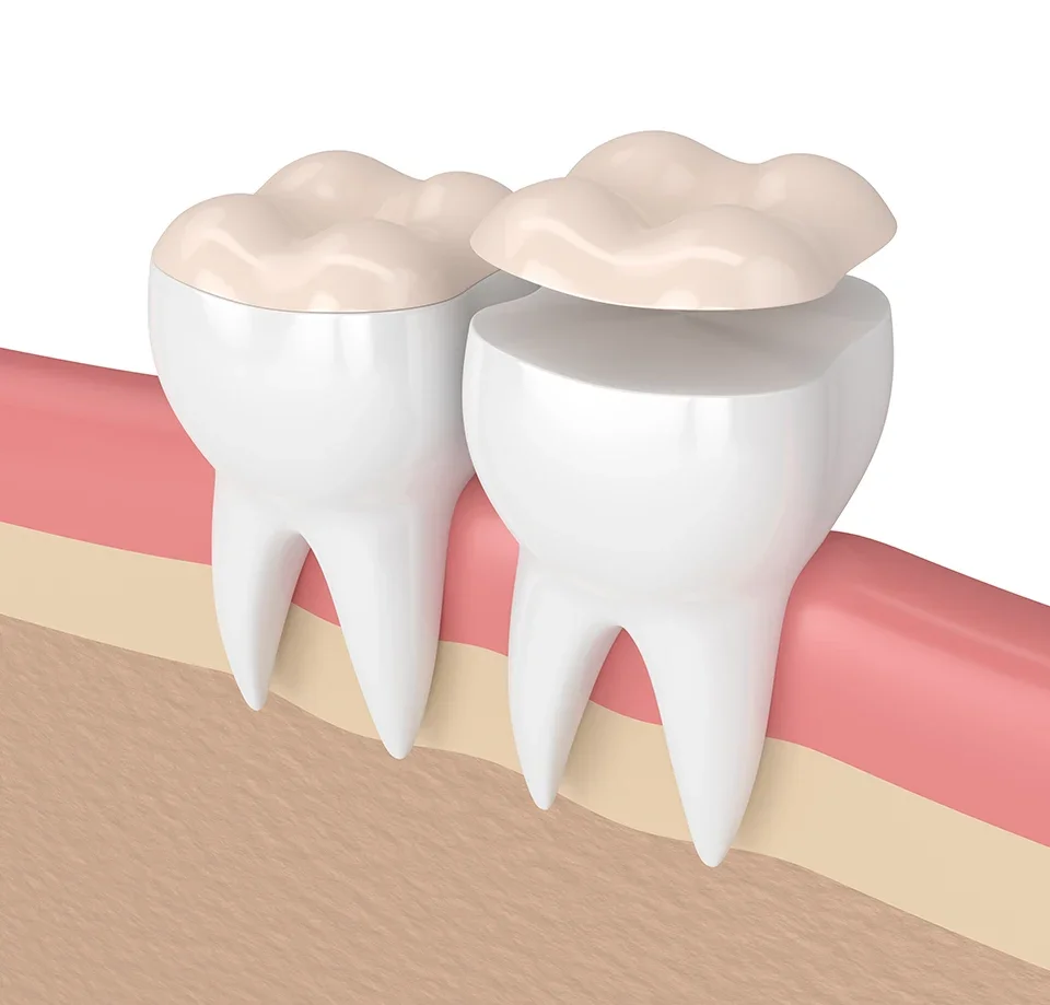 Mini Dental Implants