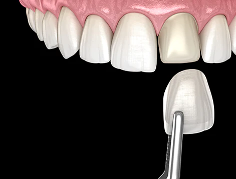 Benefits of Dental Veneers