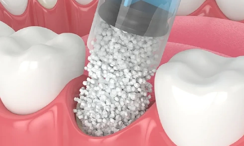 Bone Grafting