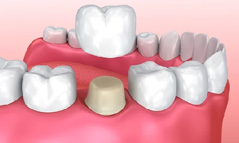 Dental Crowns