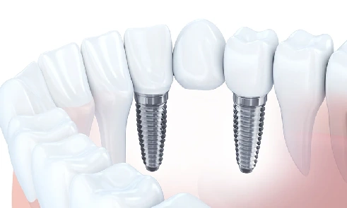 Dental bridge