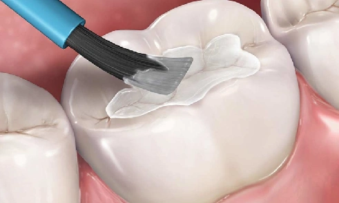 Fluoride Treatments & Dental Sealants