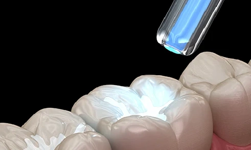 Fluoride Treatments & Dental filling