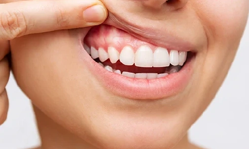 Non-Surgical Gum Disease Therapy