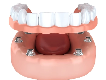 Implant-Supported Dentures​