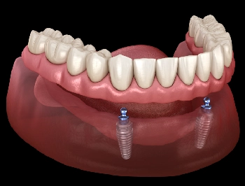 Mini Implants for Denture Stabilization