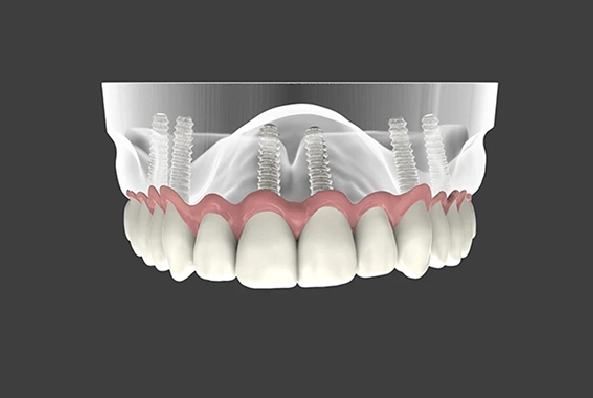Who Needs Full Mouth Dental Implants_