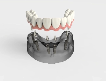 all on 6 dental implants